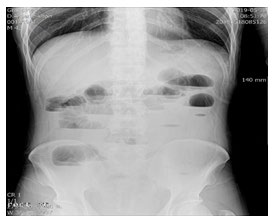 Figure 1: Transabdominal US. Bowel loops is dilated about 3 cm.