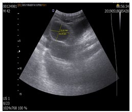 Figure 2: PA erect Abdominal Radiography, Multiple air- fluid levels.