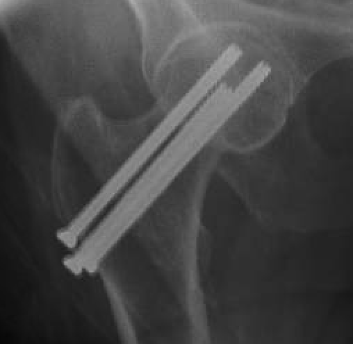 Figure 3: Condensed screw fluoroscopic images with fracture through the subtrochanteric region of the femur. (b) AP and (b) Lateral.