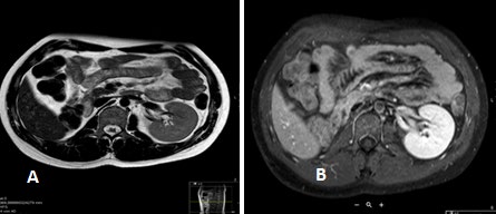 Figure 1: (a) T2 w TSE axial (b) T1 w TSE with Fat suppression with contrast media: showing absence of right kidney, left kidney normal.