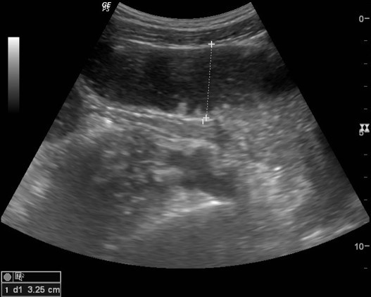 Figure 1: Abdominal US demonstrates multiple dilated small bowel loops (32.5 mm).