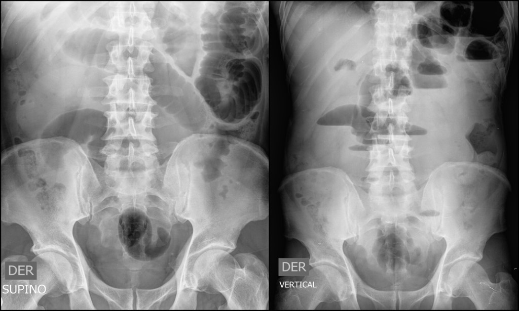Figure 2: Abdominal x-ray showing multiple air-fluid levels with distal air in the rectum, in keeping with a low grade small bowel obstruction.