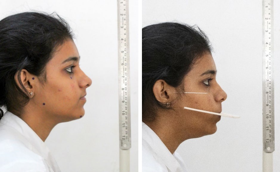 Figure 1: Photographic landmarks palpated on patients face and adhesive sticker placed for identification of landmarks, Standardized photograph with marking FH plane on patient and orienting it parallel to floor.