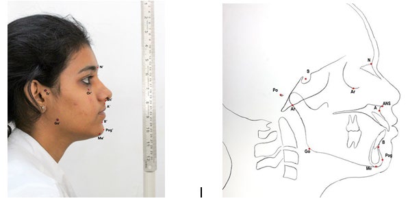 Figure 2: a. Photographic landmarks = N’, indicates soft tissue nasion; Tr’, tragion; Or’, Soft tissue orbitale; A’, Soft tissue subspinale; B’, soft tissue supramentale; Go’, soft tissue gonion; Pog’, soft tissue pogonion; Me’, soft tissue menton; Sn’,subnasale;Adhesive dots were placed on Tr’, Or’and Go’. The Me’ point was marked with an adhesive sticker to allow better visibility by the camera. b. Cephalometric landmarks= N, indicates nasion; Ar, articulare ; Or, orbitale; A ,point A, ; B, point B; Go, gonion; Pog, pogonion; Me, menton; S’,midpoint of sella; Po, porion, ANS, anterior nasal spine The following points were marked on each lateral cephalograms: • Nasion (N), Orbitale (Or) Porion (P) Point A (A) Point B (B) Menton (Me) Anterior nasal spine (ANS) Gonion (Go) Pogonion (Pog) Digital cephalograms were analyzed with software NemoCeph and photographs were analysed using Adobe Photoshop CC 2019 Version 20.0.0 (Adobe Systems, Inc., San Jose, CA, USA) [10]. The images were opened in the nemoceph software and calibration was done after plotting the points on the cephalograms the software automatically calculated all the measurements. The image was also opened in Adobe Photoshop CC 2019 Version 20.0.0 (Adobe Systems, Inc., San Jose, CA, USA) and was adjusted by using the ruler option in the frame. In Adobe Photoshop, the measurements were taken by drawing a line with the ruler tool, angle and linear measurements was recorded in the measurement log panel. A computerized analysis of facial morphology through radiographs and photographs was performed by the same operator in blind design.