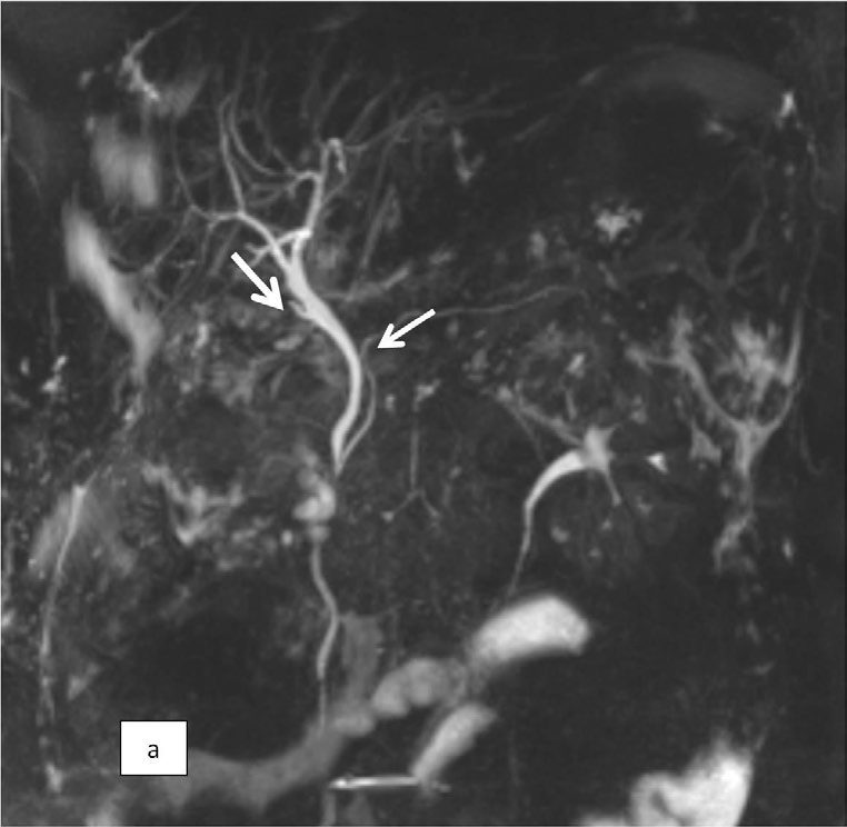Figure 1: Post op MRCP of the patient. Arrows marked on cystic duct stump, common bile duct.