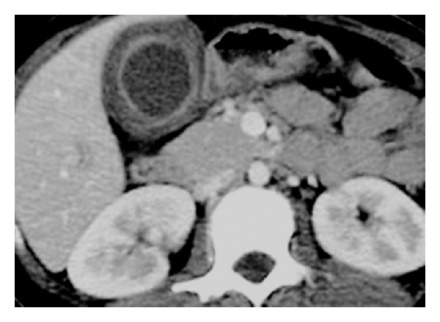 Figure 1: CT scan showing thickened Gall bladder with continuous contrast enhanced mucosal line.