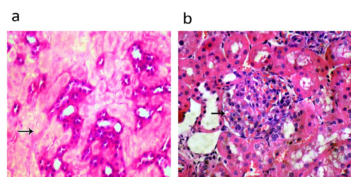 Figure 3: The depicted figure shown a) kidney of lactating dams treated with 1/10 LD50 of CFP orally from 0th - 21th days postpartum showing degenerative changes and necrosis of renal tubular epithelium (HE, 400x). (b) Kidney of suckling pups of treated dams with 1/10 LD50 of CFP orally from 0th - 21st days postpartum showing congestion of renal glomeruli (arrow) (HE, 400x).