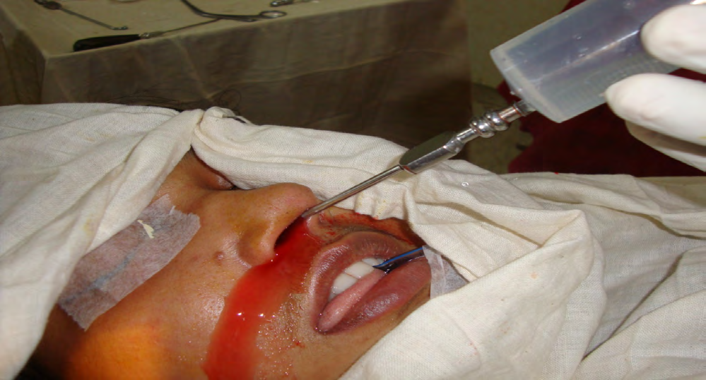 Figure 2: Irrigation of maxillary sinus through the middle meatus using antrum sucker nozzle, 50 cc syring and normal saline.