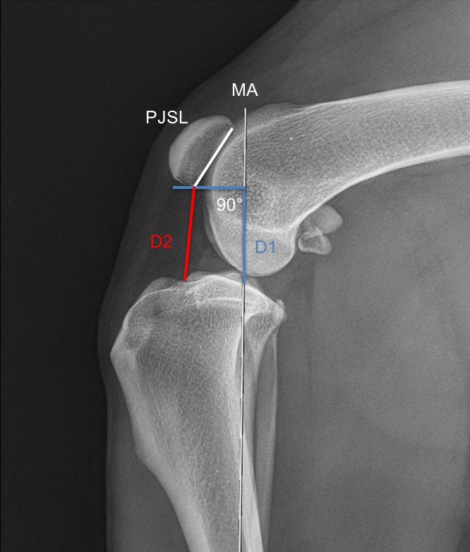Figure 2: Mediolateral radiograph of the stifle of Figure 1 digitally duplicated with the stifle joint angle at 90° illustrating the measurements made to determine the CDI and GVI.