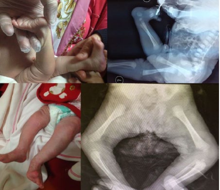 Figure 1: Deformity with hyperextension on her knees at birth (a); the tibia dislocated anteriorly at birth (b); spontaneous flexion posture on knees at seventh month (c); normal tibia location at seventh month
