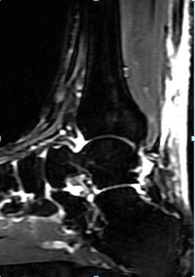 Figure 3: Open Achilles tendon repair.
