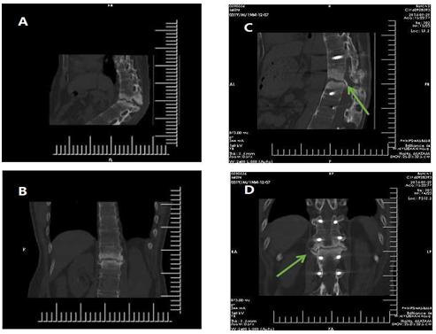 Figure 2: Sagittal (A) and coronal (B) reconstructed CT images show central osteolysis surrounded by an irregular sclerotic zone before the operation. Sagittal (C) and coronal (D) reconstructed CT images of 14 months after the operation reveal consecutive callus formation just as the arrows show.