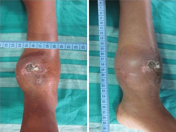 Figure 1: Clinical dimensions of swelling above ankle with skin involvement in 12 years old boy.