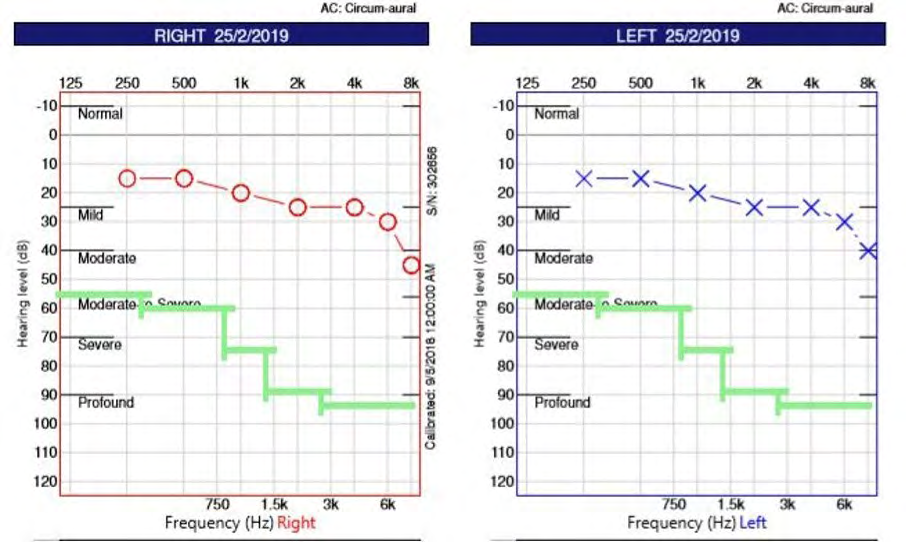 Figure 2: Audiogram of patient tested February 2019.