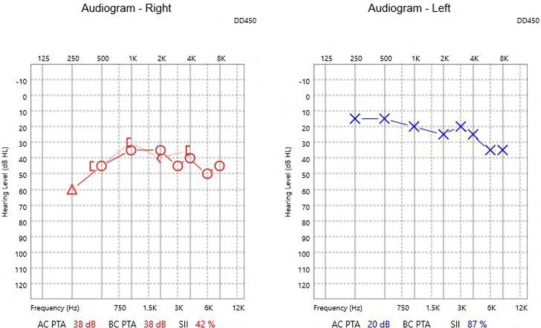Figure 3: Audiogram of patient tested May 2020.