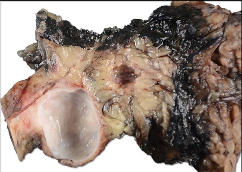 Figure 2: Gross photograph of distal pancreatectomy. The specimen is bilvalved to reveal a 2.6 cm unilocular cystic mass, which does not communicate with the main pancreatic duct. No discrete masses are seen adjacent to the cyst.