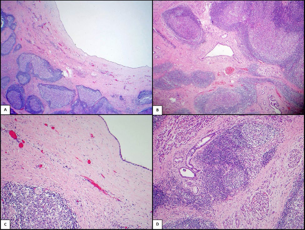 Figure 3: Low power view shows part of the cyst with surrounding lymphoid follicles (A). The reactive lymphoid follicles are located around both ducts and acini. No storiform fibrosis, obliterative phlebitis nor neutrophilic abscesses are seen (B&D). The cyst is lined by simple biliary type epithelium without atypia. No surrounding ovarian-type stroma is seen (C).