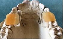 Figure 1: Construction of upper resin apparatus with indirect tracks.
