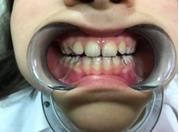 Figure 5: Occlusion with device.