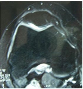 Figure 1: Normal patella in MR (Hacettepe University records).