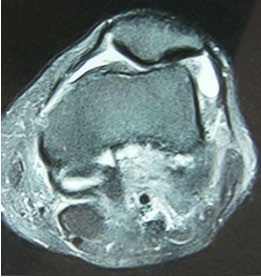 Figure 2: Patella with lateral slope in MR (Hacettepe University).