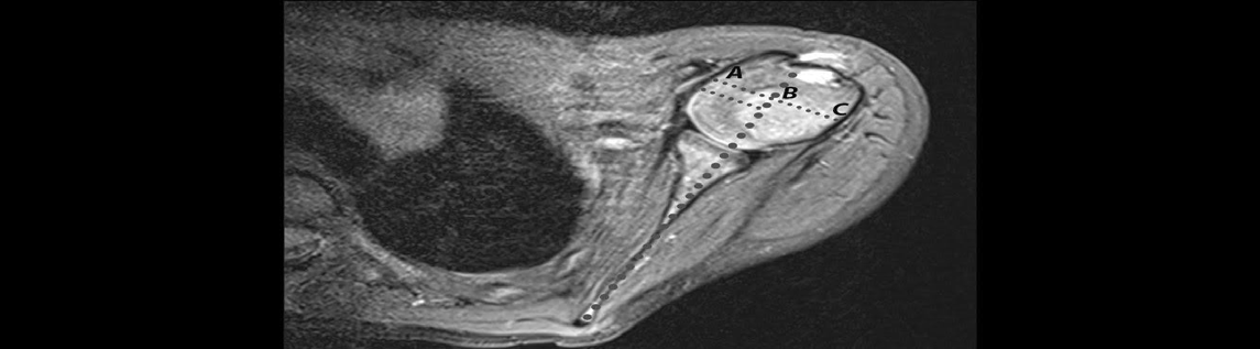 Figure 2: A) Preoperative period, 1-year-old-female patient B) Postoperative period, after 34 months follow-up. In follow-up, preoperative PHHA value measurement in MRI axial sections with T2 sequences of a case in our clinic. In follow-up, increase in PHHA draws attention.