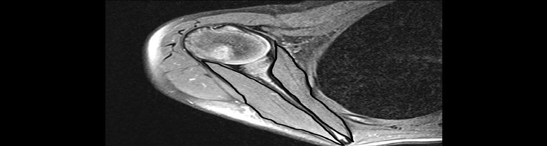 Figure 3: A) Preoperative period, 2-year-old-female patient B) Postoperative period, after 50 months follow-up. Areal measurements are made via T1 sequenced MR transverse sections in which subscapularis (SS) and external rotator muscle groups (infraspinatus and teres minor) (ER) appear in the widest extent. Correlating with the amount of pixels in areal measurement, Adobe Photoshop CS6 Extended program give the intervening area as the number of pixels by marking curvilinear marked lines as pixel. They have been included in comparative evaluation to gain volumetric meaning by being cubed of square roots of proportioning to each other. In the figure it is shown areal measurements for volume changes in muscle in preoperative and postoperative MRI scans of a patient with radiographic follow-up of 50 months.