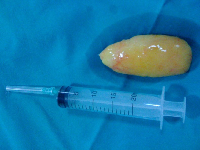 Figure 6: Carpal tunnel release.