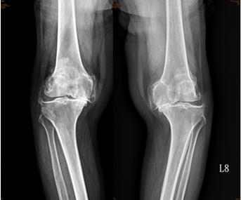 Figure 3: severe varus pre-Op.