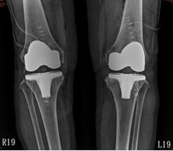Figure 7: Three Months Post Op.