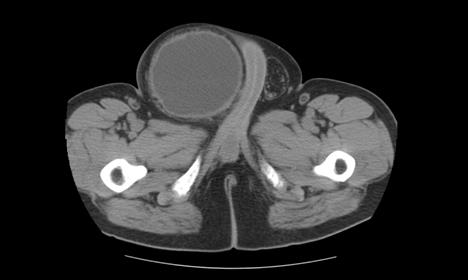 Figure 3: The patient was admitted and monitored for post obstructive diuresis. He received intravenous fluid resuscitation and by hospital day-two his serum creatinine had normalized. On hospital day-three, he was taken to the Operating Room for an inguinal hernia repair and reduction of bladder hernia. At the time of surgery, it was observed that the majority of the patients’ bladder (including the trigone, ureters and dome) was herniating into his right hemi-scrotum.