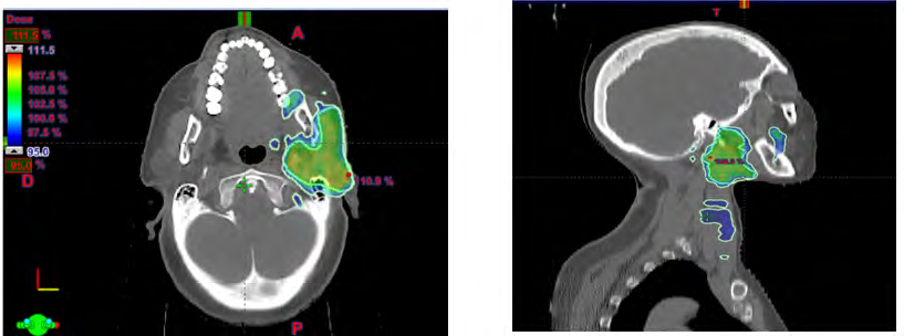 Figure 2: Example of dosimetry of adenoid cystic carcinoma (axial and sagittal slices). green: high risk PTV; blue: intermediate risk PTV.