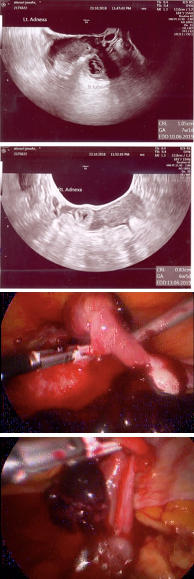 Figure 1: ** Ectopic pregnancy.