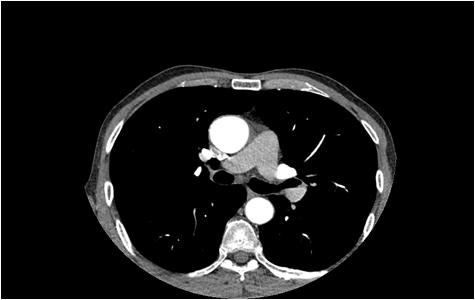 Figure 1: TEE Computed Tomography scan.