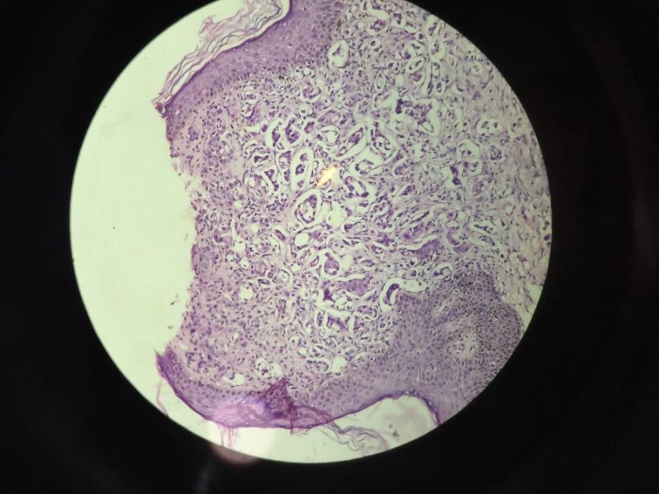 Figure 3: Histopathology, Pleomorphic and hyper chromatic malignant cells predominant in sub epidermis and upper dermis in the form of clusters and glandular structures.