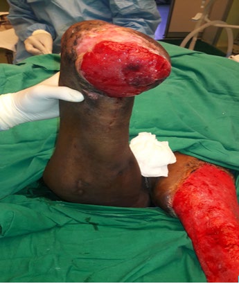 Figure 1: Wound over the amputation stump.