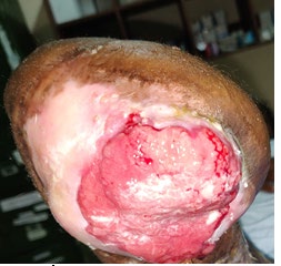 Figure 3: Topical cholecalciferol therapy given to the amputation stump.