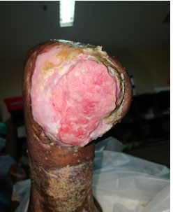 Figure 4: Healing wound bed.