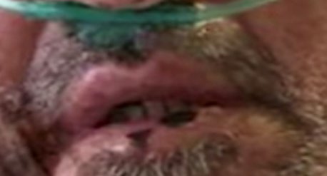Figure 3: Hard erythematous tissue and fibrin.