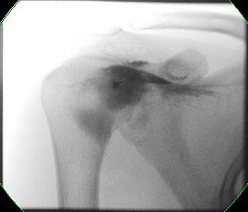 Figure 1: Fluoroscopy guided injection into the right shoulder. No pectoral tears.
