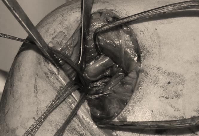 Figure 2: Use of Fiber-tape Sutures to tie the pectoral tendon to humerus.