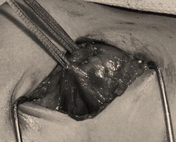 Figure 3: Fibre-tape Sutures.