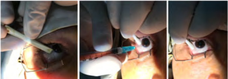 Figure 1: Intravitreal injection.