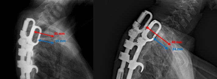 Figure 4: Radiograph illustrating an increase in the translational distance between the instrumented rib-based anchor and anterior vertebral body at 2-year follow-up.