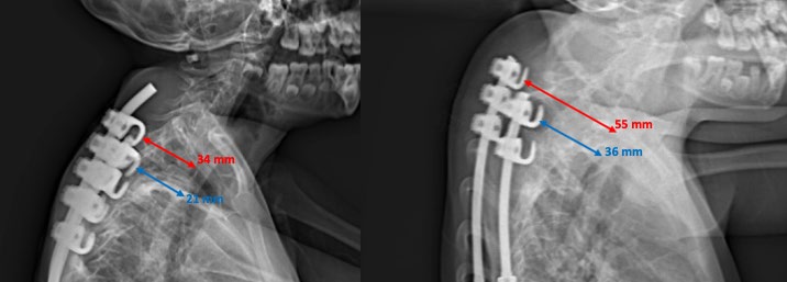 Figure 5: Radiograph illustrating an increase in the translational distance between the instrumented rib-based anchor and anterior vertebral body at 2-year follow-up.