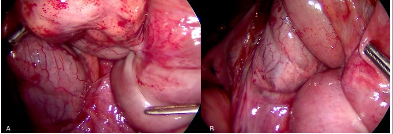 Figure 2: Laparoscopic view of the point of meeting between the fixation of both 1st bowel loop and last one (A, B). Figure 2.A shows the 1st jejunal loop under traction displaying its fixation and mimicking an internal hernia with upstream occlusion.