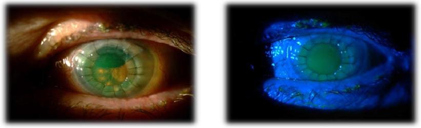 Figure 1: Slit-lamp images of the left eye (case 1) two weeks after PKP.