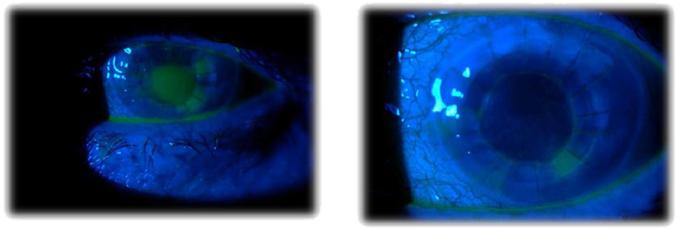 Figure 2: Slit-lamp images of the left eye (case 1) one week (A) and four weeks (B) after treatment with Cacicol20.