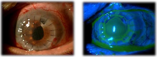 Figure 3: Slit-lamp images of the left eye (case 2) one day (A) and one week (B) after PKP.