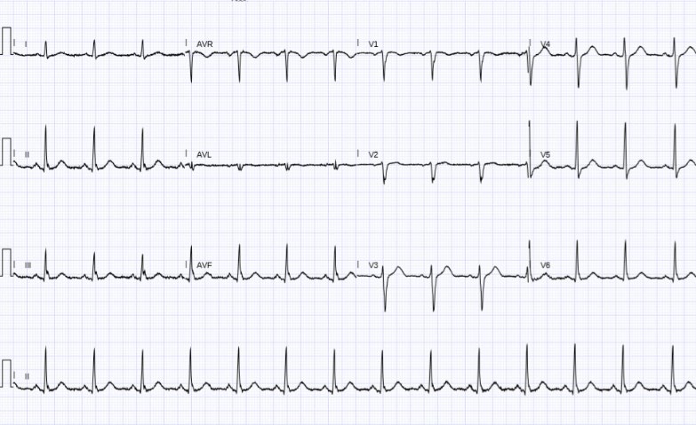 Figure 3: Normal ECG.